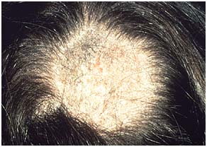 Bệnh nấm tóc